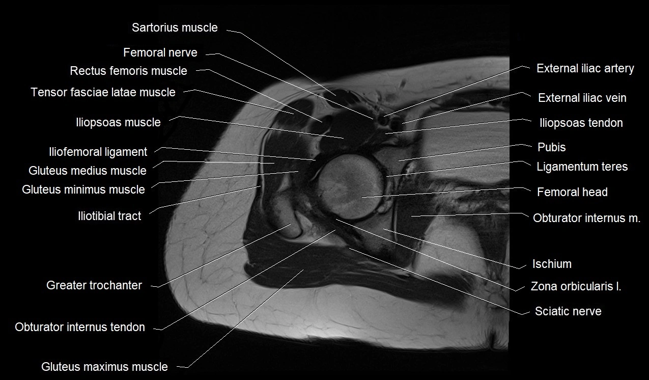 MRI thigh cross sectional anatomy image 7.webp